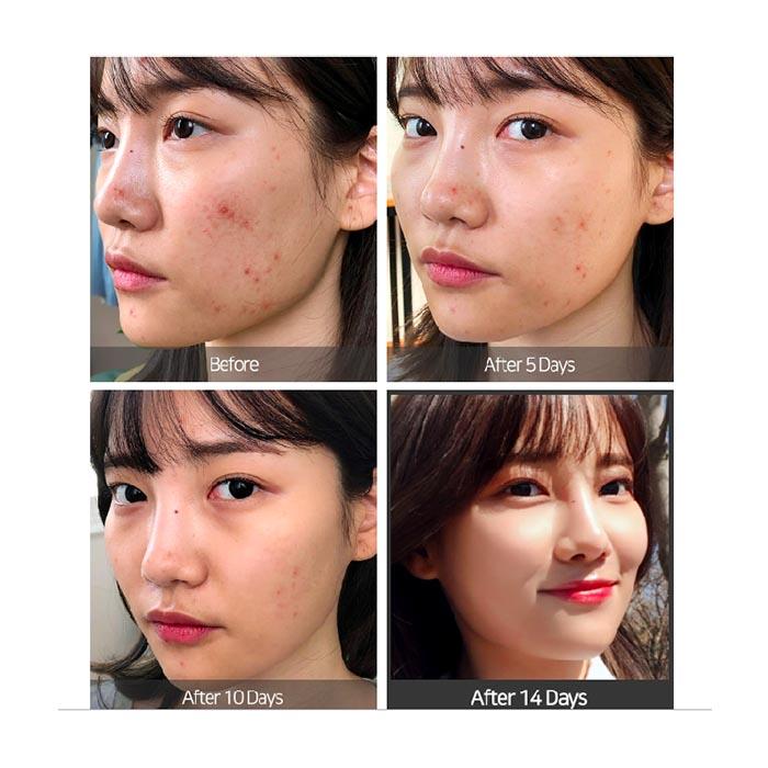 Somebymi Super Miracle Spot All Cream (acne spot care),30ml